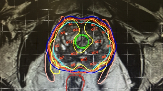 详细的医学图像有助于医疗卫生专业人员区分肿瘤、健康组织和器官，以确保放射源正确对准治疗部位。  （图/ Auna Oncosalud）