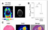 新的放射性示踪剂可识别肿瘤中的铁含量