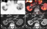 SPECT/CT比CT在诊断肾癌方面更有价值