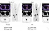 FAPI-PET将示踪剂注入等待时间减少了三分之二以上