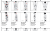 长达数年的研究指出淋巴瘤深度学习PET成像模型的临床潜力